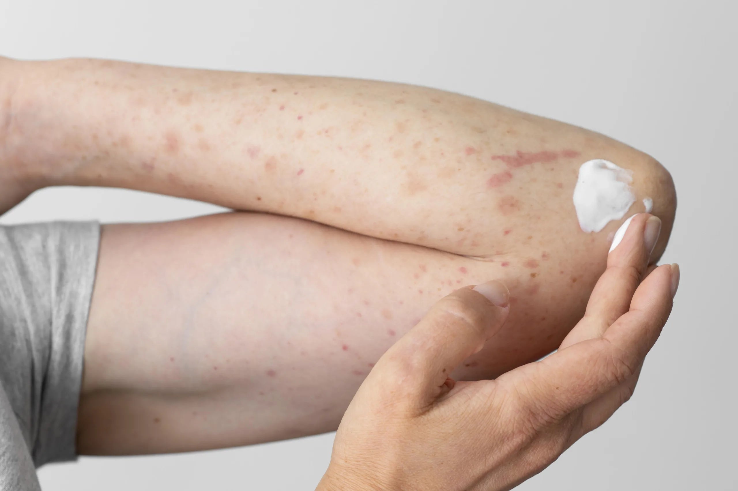 Cuidados com a Pele para Pessoas que Sofrem de Eczema